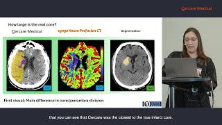 Maximillian Thormann Comparison of Accuracy of CT Packages in Patients with Acute Ischemic Stroke [upl. by Penney]