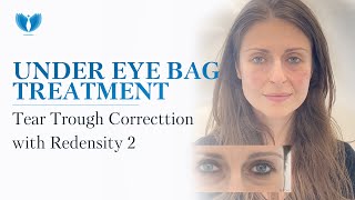 Tear Trough Treatment  Under Eye Area Correction with Dermal Filler Redensity 2  Under Eye Bags [upl. by Elisee]