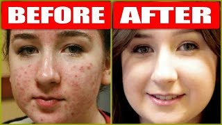 How To Remove Pimples Overnight With Just 1 Product  Acne Treatment  RABIA SKIN CARE [upl. by Ayhtak]