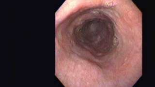 Achalasia Vs Pseudoachalasia [upl. by Oiramad]