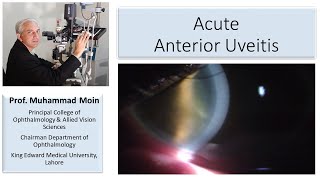 What do you see in Acute Anterior Uveitis [upl. by Kosel]