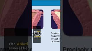 Painless Pulmonary Vein Isolation Your Ultimate Guide to Atrial Fibrillation Ablation [upl. by Naam]