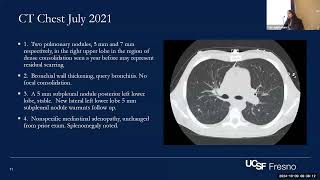 Central Valley Chronicles Challenging Coccidiomycosis Cases in PWH [upl. by Ellitnahc75]