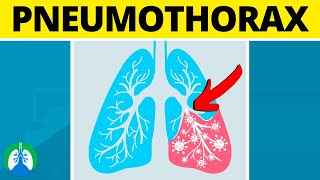 Pneumothorax Medical Definition  Quick Explainer Video [upl. by Mullen988]