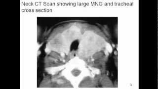 Multinodular Goiter Evaluation and Management [upl. by Kcired109]