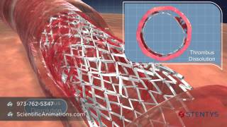 3D Medical Animation of Coronary Stent Procedure [upl. by Ellenrahs481]