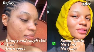 How to get Smooth skin on the face✅ Get rid of tiny bumps and roughness on the face No acne spots [upl. by Phyllida618]