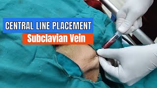 Central Line placement Subclavian Vein Approach [upl. by Aerbua]