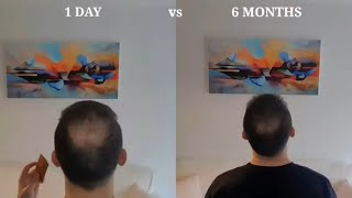 How to Derma Roll for Hair Regrow  My Half a Year Results [upl. by Ydarg]