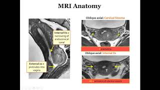 International Cancer Imaging Society Course Oct 17 Imaging uterine tumors Alberto Vargas [upl. by Claybourne]