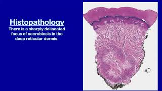 Lecture110 Necrobiotic Granulomatous Disorders of the Skin Rooks chapter 97 [upl. by Aba]