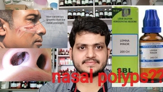 Nasal polypsHomeopathic medicine for nasal polyps explain [upl. by Eynaffit65]