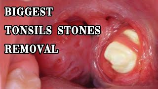 biggest tonsils stones removal tonsilolith hidden huge tonsils stones removal [upl. by Reham]