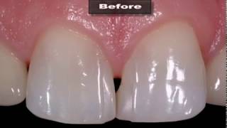 Mid line Diastema Closure with Bioclear [upl. by Nytsirc]