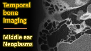 Temporal Bone Imaging  Glomus tympanicum amp other middle ear neoplasms [upl. by Banquer]