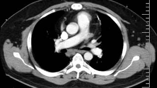 Mediastinal Anatomy on CT Discussion by a Radiologist [upl. by Risay779]