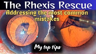 THE RHEXIS RESCUE  My top pearls Addressing the most common mistakes  Dr Deepak Megur [upl. by Andrew780]