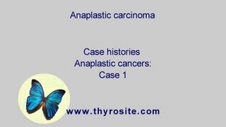 Anaplastic carcinoma  case 1 [upl. by Sihtam]