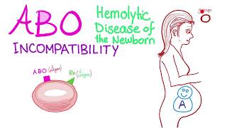 ABO Incompatibility  Hemolytic Disease Of The Newborn HDN  Hematology amp Pathology [upl. by Damicke233]