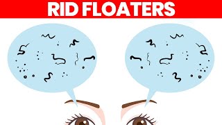 Eye Floaters What Are They amp How to Get Rid of Them [upl. by Ecnedurp]