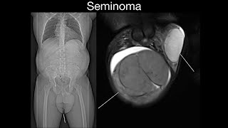 Seminoma [upl. by Burn]