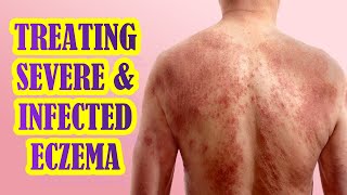 How To Manage Infected and Severe Eczema  Treatment Options [upl. by Thorbert]