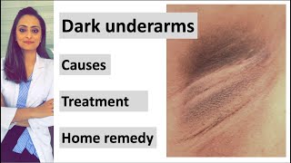 How to get rid of Dark underarms  causes treatment home remedy Dermatologist  Dr Aanchal [upl. by Stortz]