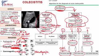 Colecistitis [upl. by Auguste]