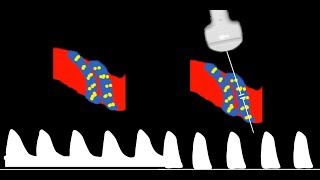 Umbilical Artery Doppler interpretation [upl. by Prestige20]