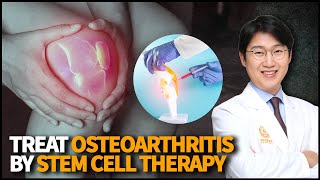 How to treat Osteoarthritis Degenerative Arthritis using Stem Cell Therapy [upl. by Gavette]