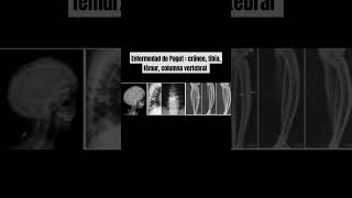 ENFERMEDAD DE PAGET CRÁNEO TIBIA FÉMUR COLUMNA VERTEBRAL  PELVIS [upl. by Jacki]