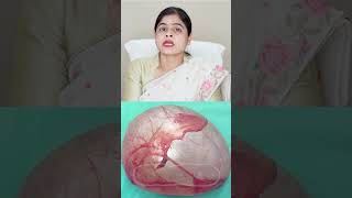 Serous Cystadenoma or Mucinous Cystadenoma  Dr Soniya Singh  Narayan Swaroop Hospital [upl. by Acinoryt]