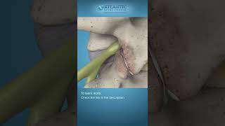 What is Endoscopic Lumbar Foraminotomy Shorts Atlantic Spine Center [upl. by Frear]