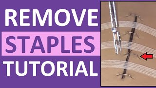 Surgical Staple Removal Nursing  How to Remove Surgical Staples [upl. by Amlez]