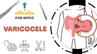 Varicocele by ASM Minds [upl. by Ogait254]