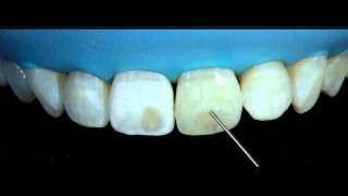 Removal of white spots on teeth with DMG ICON [upl. by Izzy458]