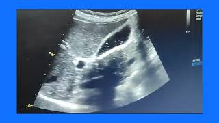 Empyema gallbladder or pyocele or suppurative cholecystitis ultrasound and color Doppler video [upl. by Grimona]