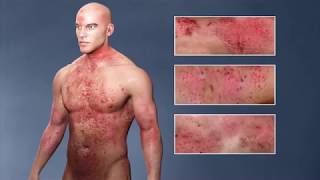 Atopic Dermatitis eczema From the Inside Out [upl. by Aran163]