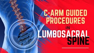 Mastering CArm Guided Interventional Pain Procedures at Lumbosacral Spine Tips for Pain Physicians [upl. by Charmain66]