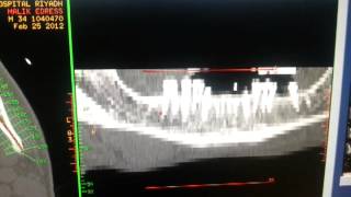 How to do a Dentascan CT of the mandible [upl. by Afihtan125]