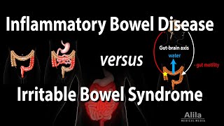 Inflammatory Bowel Disease vs Irritable Bowel Syndrome Animation [upl. by Abisha]