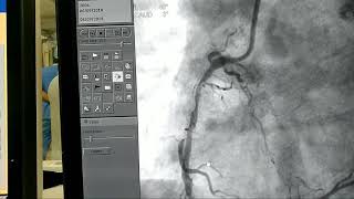 In stent restenosis ISR [upl. by Ciprian503]