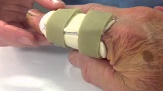 How to Splint Index Finger After Surgery to Repair Severed [upl. by Anthia]