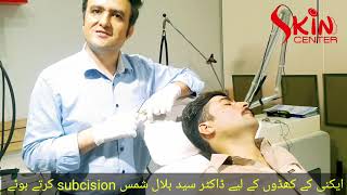 Acne scars treatment via Subcision by skin specialist Dr Syed Bilal Shams [upl. by Akessej791]