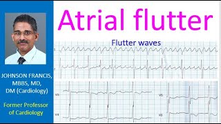 Atrial flutter [upl. by Marutani]