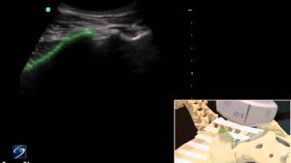 How To Ultrasound Guided Sacroiliac Injection  Sonosite Ultrasound 3D Video [upl. by Ocramed]