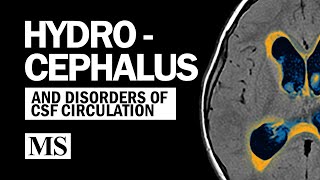 Hydrocephalus And the Disorders of CSF Circulation [upl. by Feune283]