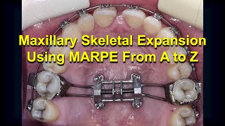 Maxillary Skeletal Expansion using MARPE from A to Z Updated [upl. by Iridissa897]