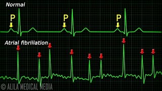 Atrial Fibrillation Anatomy ECG and Stroke Animation [upl. by Muryh38]