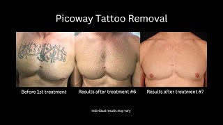 Picoway Laser for Tattoo and Brown Spot Removal [upl. by Atinra]